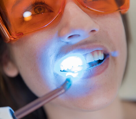 Dental Bonding in Lynnwood