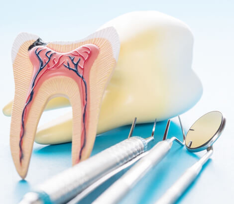 Root Canals in Lynnwood