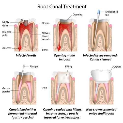 Root Canal Treatment procedure diagram