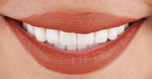 After — Smile Makeover