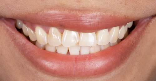 Before — Smile Makeover