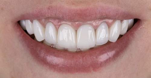 After — Cosmetic Restoration