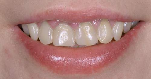 Before — Cosmetic Restoration